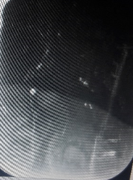 Radiograph showing two natal teeth without root, present superficially and appears conical in shape