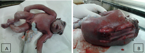 A & B – showing anencephaly fetus with craniospinal rachischisis