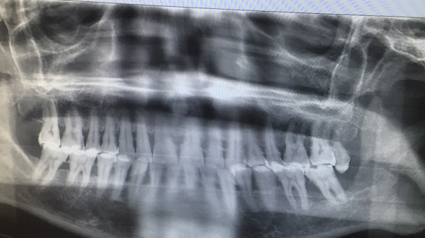 Generalized horizontal bone loss