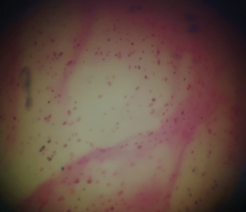 Inflammatory lesion