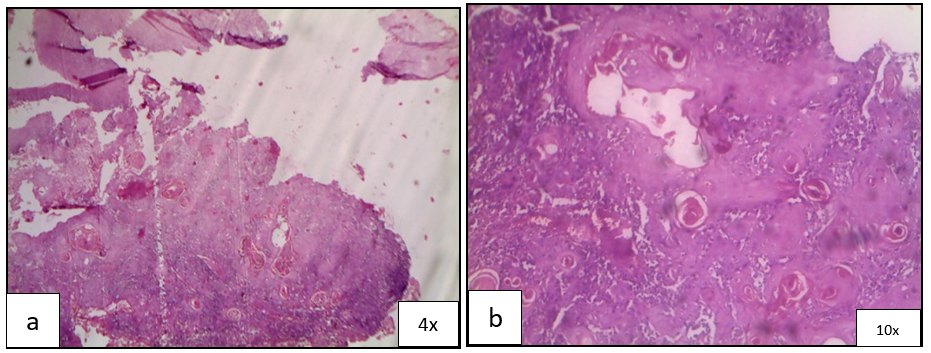 a); Islands and sheets of malignant squamous epithelial cells infiltrating into the connective tissue; b): The neoplastic cells exhibit numerous keratin pearl formation