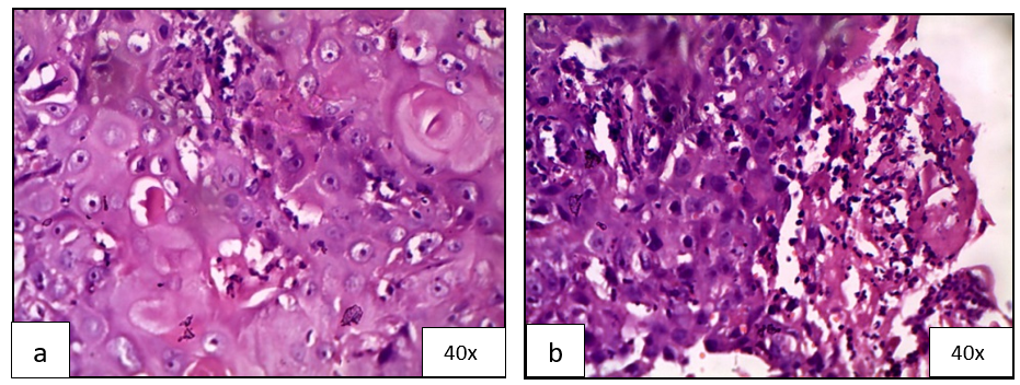 (a)(b) Higher magnification showing neoplastic cells with numerous keratin pearl formations, nuclear and cellular pleomorphisms, and mitotic figures. Few dilated blood vessels were also noted