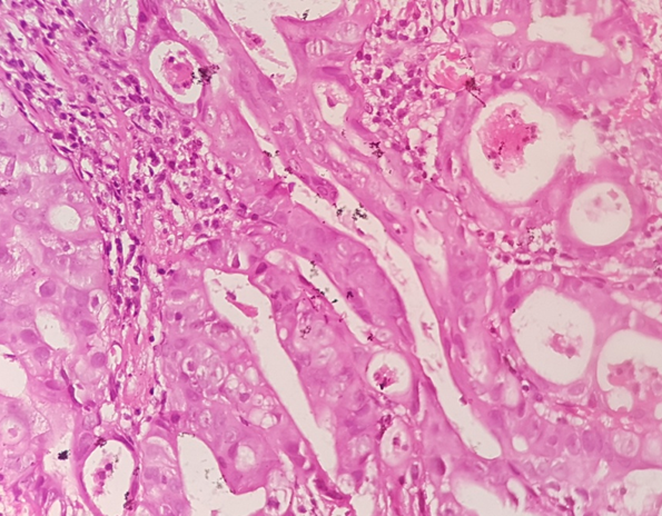 Microscopy of Moderately differentiated adenocarcinoma of esophagus( H & Ex400)