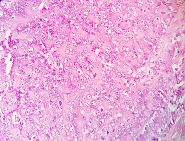 Microscopy of poorly differentiated adenocarcinoma of rectum (H & Ex100)