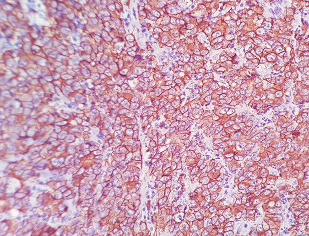 High power view (Her-2/neu x400)