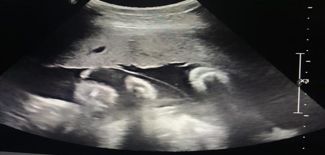 Sonological finding showing twin pregnancy with two separate membranes-Dichorionic twins.