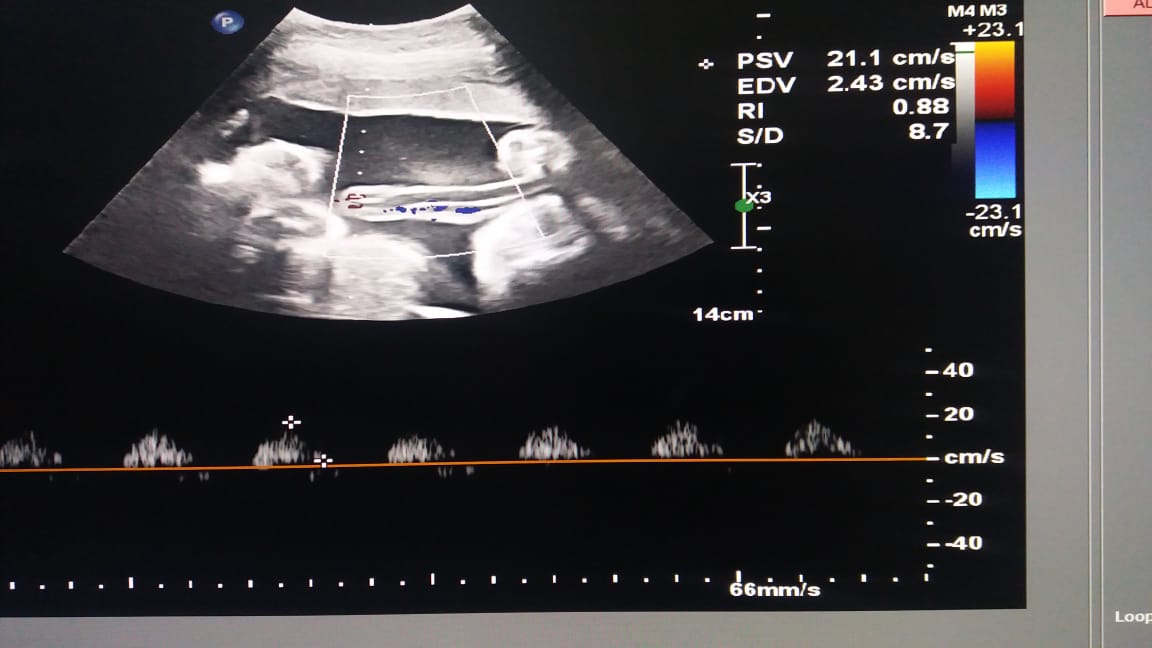 Ultrasonography view of Umblical cord with two arteries and one vein.