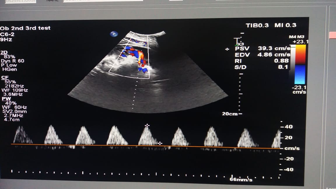 Colour Doppler studies showing Diastolic flow reversal of uterine artery.