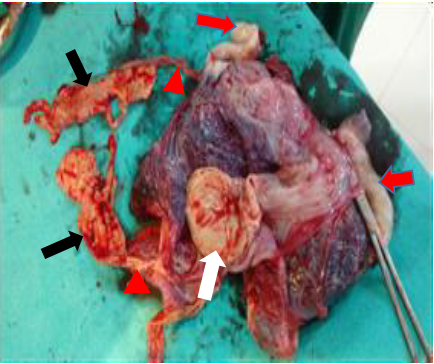 The picture shows the placenta with two healthy umbilical cord attachments. Three paper like compressed foetuses can be seen attached to the placenta with necrosed cords. The Black arrows shows the two fetusses of apprximately 13 wks of gestational age. The white arrows the foetus at 9 weeks of gestational age wrapped in the membranes. The red arrows shows the umblical cords of the live babies. The red arrow heads shows the necrosed attachments of the compressed fetusses.