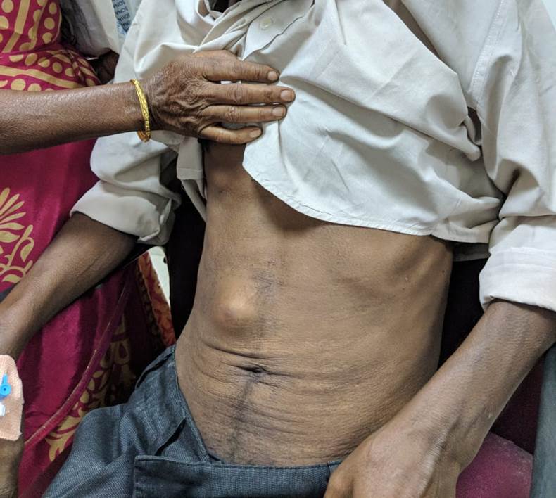 Patient with subcutaneous nodule