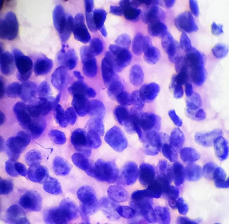 Microphotograph of FNAC from subcutaneous nodule showing metastatic adenocarcioma deposits