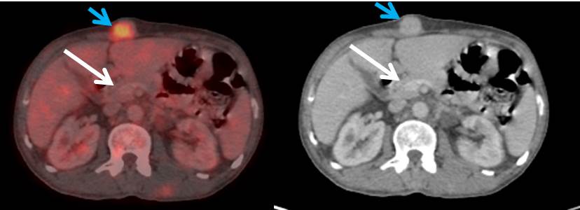 PET CT scan showing no lesion in pancreas (white arrow) and metabolically active subcutaneous nodule (blue arrow).