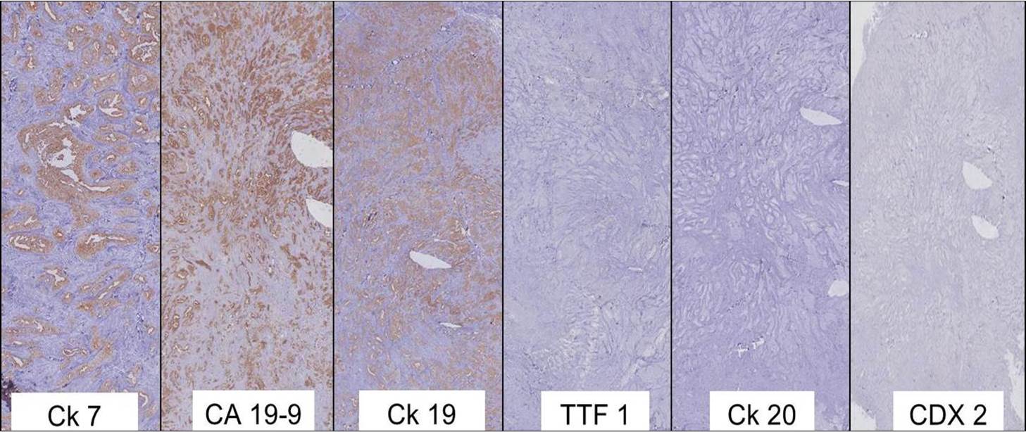 Microphotograph of Immunohistochemistry from subcutaneous nodule showing Ck 7 positive, CA 19-9 positive, Ck19 positive, TTF 1 negative, Ck 20 negative and CDX2 negative.