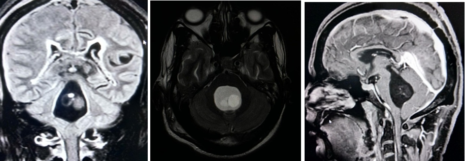 Magnetic Resonance Imaging: T1 weighted, T2 weighted & FLAIR images showing multiple cystic lesions in the 4th ventricle 