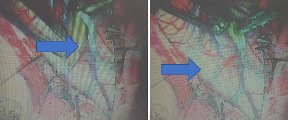Intraoperative 4th ventricular cyst – pointer 