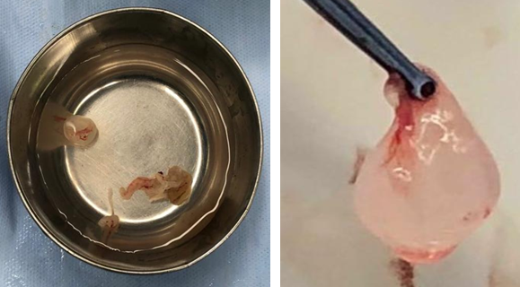 Specimen - ruptured cyst wall and the unruptured cyst.