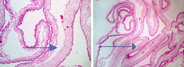  Histopathology of NCC – three layers of cyst wall