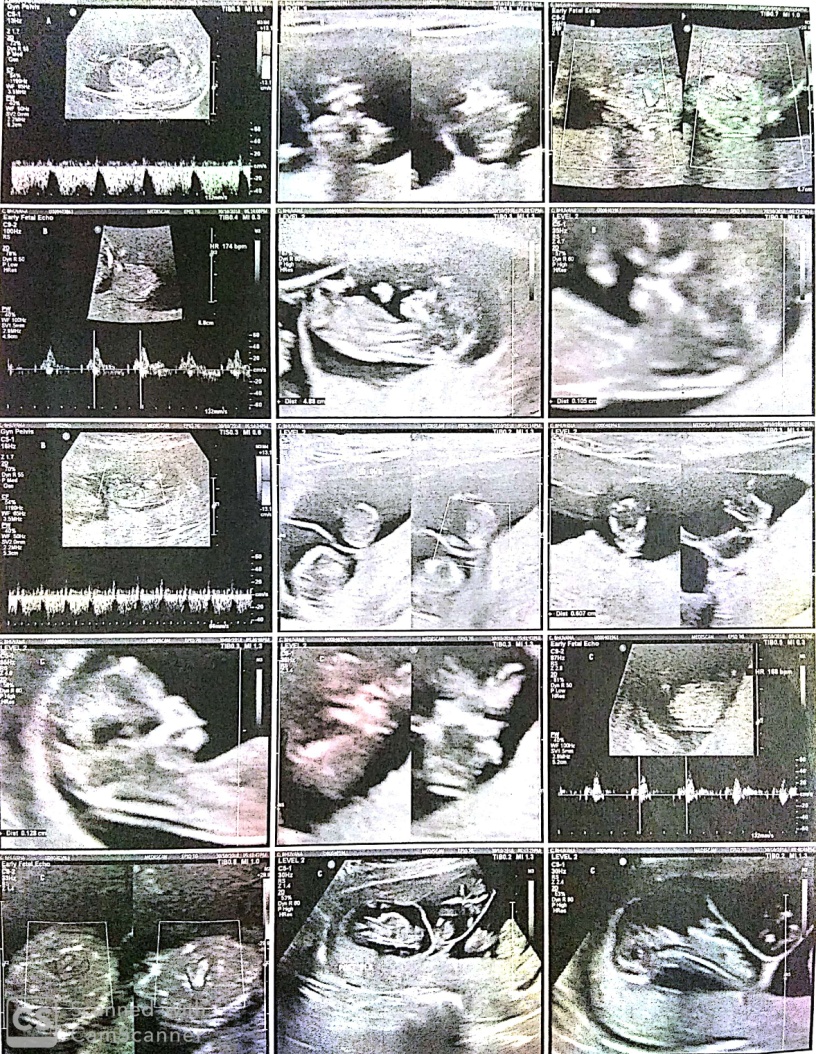 Shows quadri chorionic quadri amniotic quadruplet gestation with gestational age of 11 weeks with subchorionic hemorrhage before fetal reduction (Before Reduction)