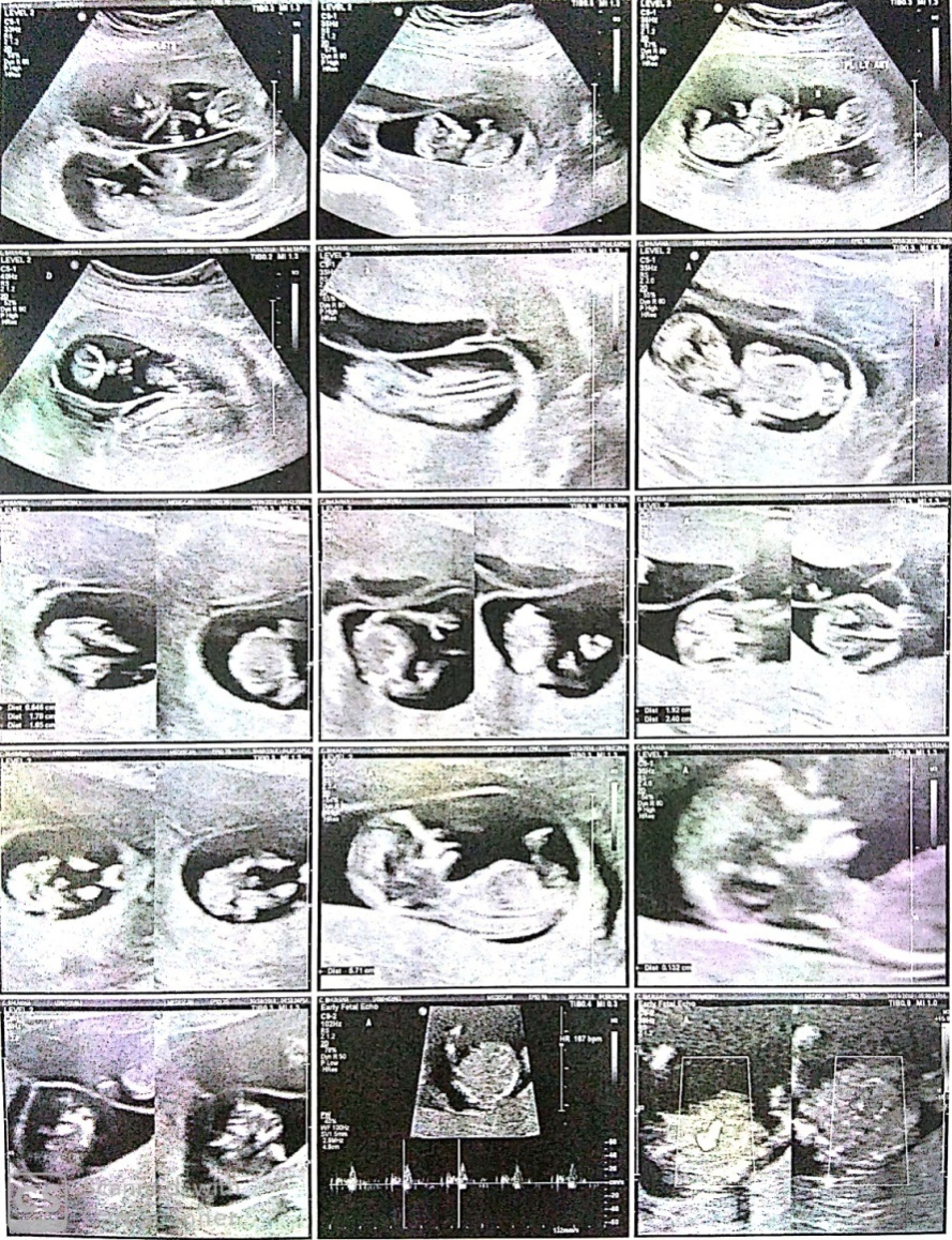 Shows fetus C and D with a systole after fetal reduction (after reduction)