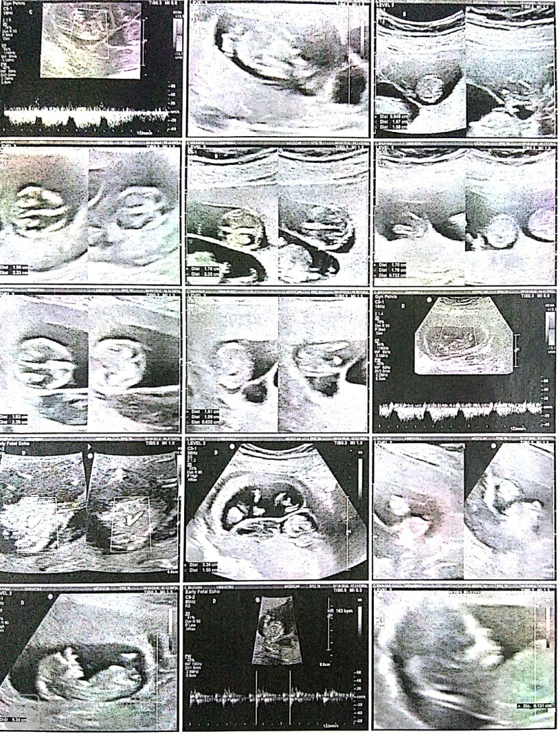 Shows normal cardiac activity of fetus A and B after reduction
