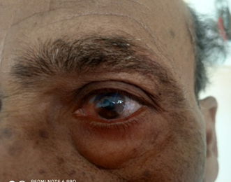 Grade 2 pterygium 