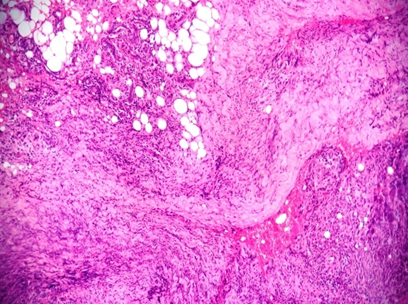 Microphotograph ofNecrobiosis lipoidica showing palisading histiocytes around necrotic collagen fibres.