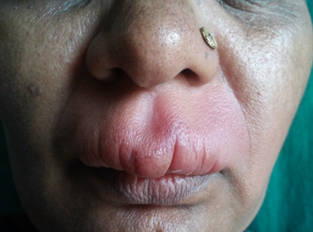 Clinical presentation of granulomatous chelitis with swelling of lips noted.