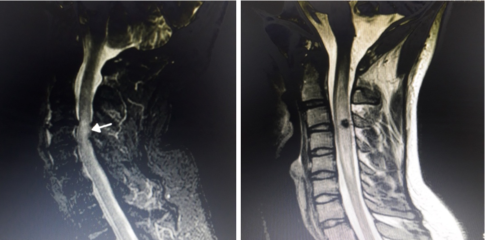 MRI picture of cord oedema and haematoma in cervical spinal cord