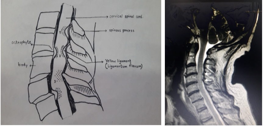 ine diagram of Pincer effect (MRI picture of Pincer effect)