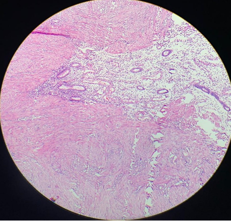 H&E(10x)- shows endometrial glands embedded in an edematous stroma. Intermixed are seen intersecting fascicles of smooth muscle fibres. 