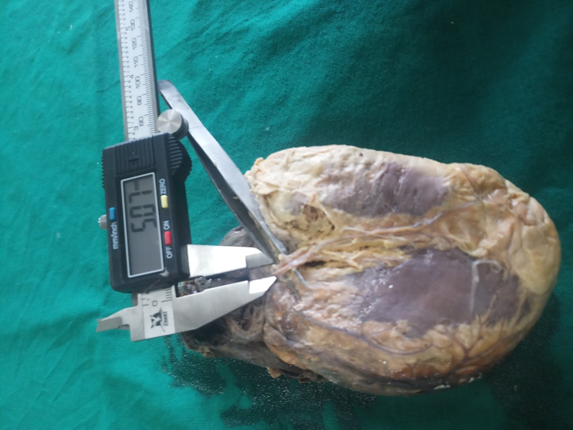 Showing measurement of diameter of middle cardiac vein with the help of digital Vernier calipers