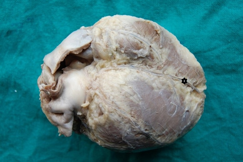 Showing middle cardiac vein(star) reaches to the apex of heart