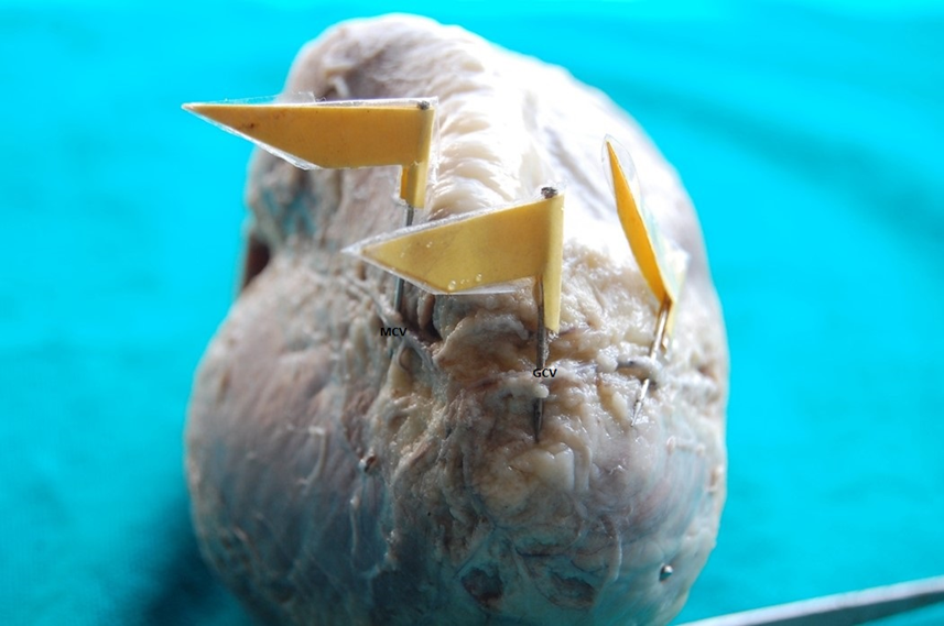 Showing anastomoses between middle cardiacvein(MCV) and great cardiac vein(GCV)