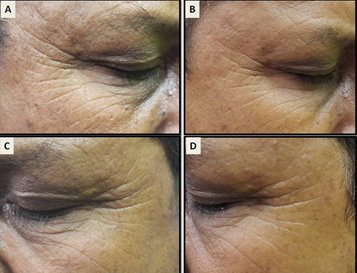 a)Periorbital wrinkles (right side) at baseline; b) 1 month post treatment with LPND; c) Periorbital wrinkles (left side) at baseline; d) 1 month post treatment with LPND