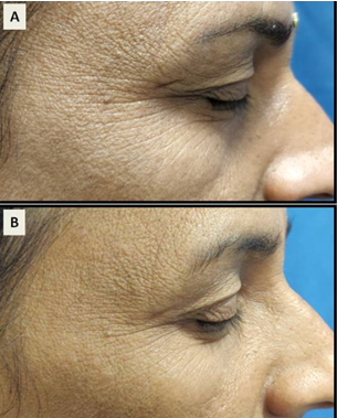 a)Periorbital wrinkles (right side) at baseline; b) 1 month post treatment with LPND