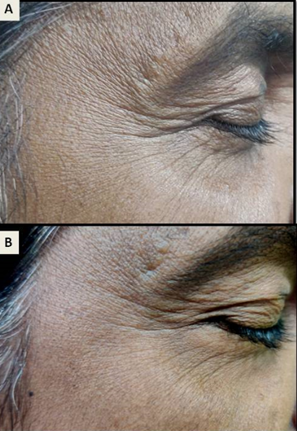 a)Periorbital wrinkles (right side) at baseline; b) 1 month post treatment with LPND