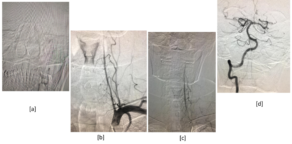 [a],[b],[c] : DSA revealing progressive smooth tapering of the distal V2 segment of left vertebral artery with evidence of slow flow; there is also no visualization of V3 and V4 segment of left vertebral artery suggestive of dissection. [d] Normal right vertebral flow.