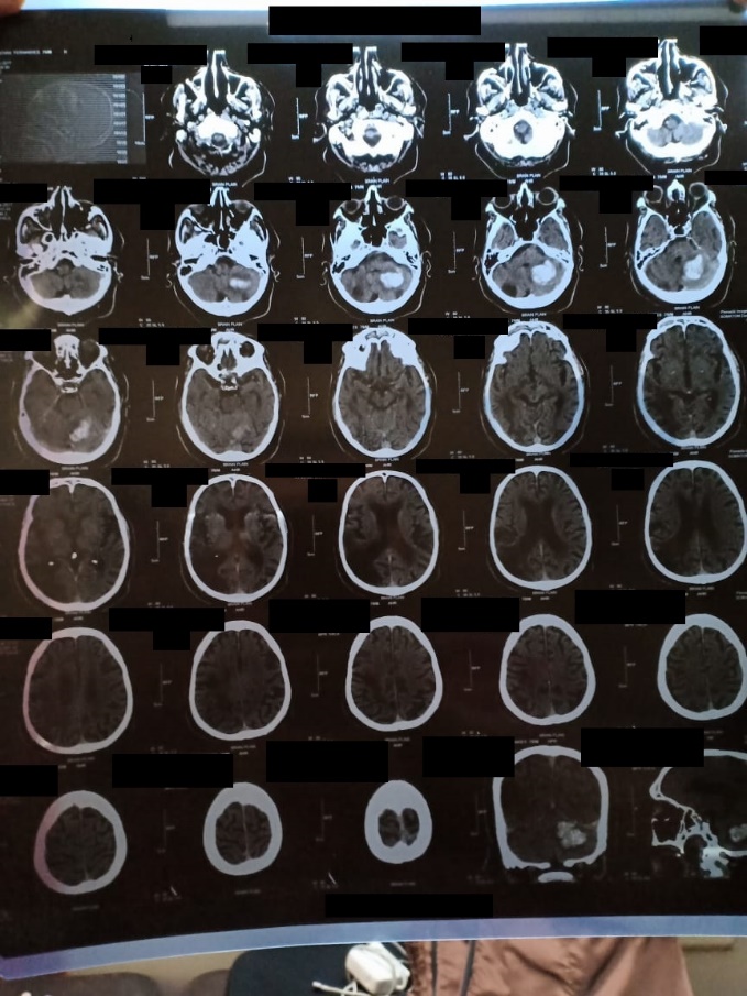 At the time of admission depicting left cerebellar haemorrhage