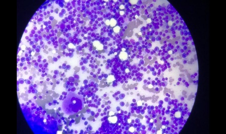 200x Photomicrograph showing bone marrow plasmacytosis in a case of Multiple Myeloma