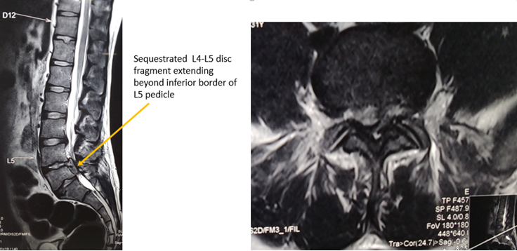 32 year old male presenting with right leg radiculopathy and inferiorly sequestrated disc very high grade down (beyond inferior pedicle)