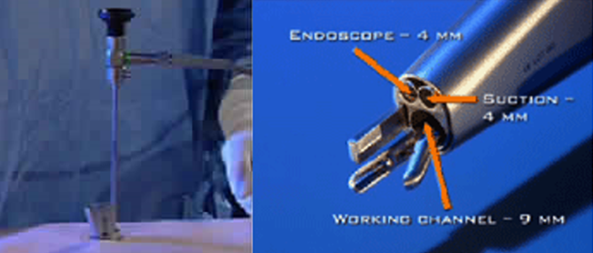 Endospine system
