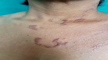 Hperkeratotic papules coalesce to form annular plaque present over the chest
