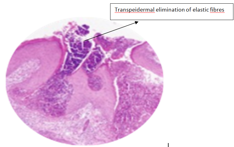 Hyperkeratotic and acanthotic epifermis with transepidermal elimination of elastic fibres.