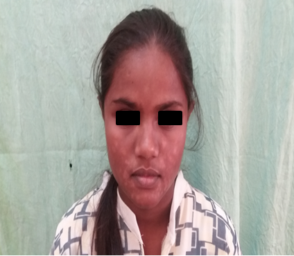 Hypopigmentation in a 16 year old female due to topical corticosteroid abuse