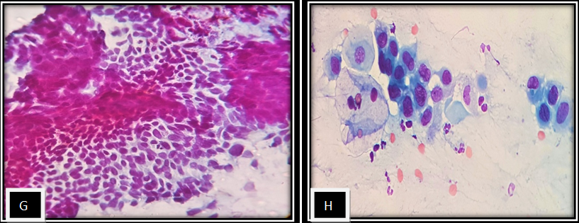 (G) SCC in PAP(10X) showing sheets of pleomorphic hyperchromatic nuclei. (H) SCC -LBC(40X). Syncytial cluster of tumour cells seen with hyperchromatic nuclei
