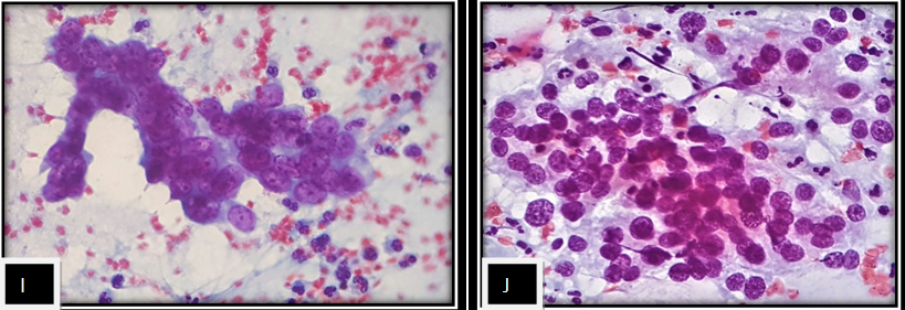 (I) Adenosquamous Carcinoma in PAP(40X) showing papillaroid fragment of large tumor cells with anisonucleosis and hyperchromatic nucleus.(J) Adenosquamous carcinoma in LBC(40X)