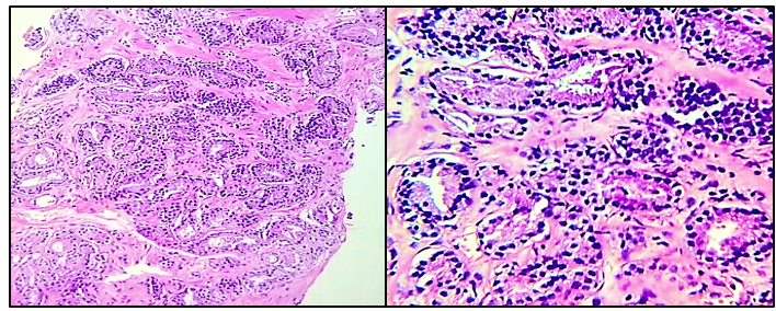 Gleason Pattern 3-Discrete glandular units, marked variation in size and shape [H&E@10X & 40X]