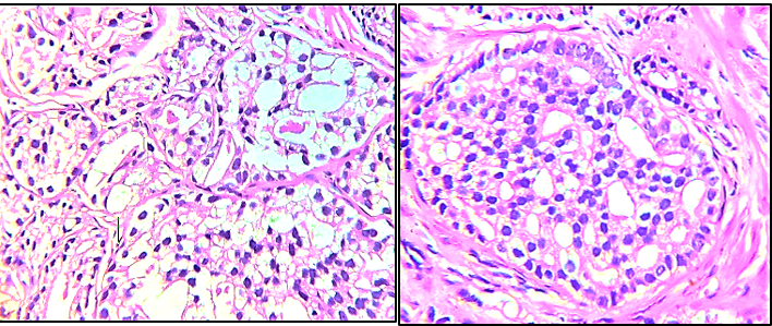 Gleason pattern 4- Fused glands and Cribriform glands [H&E@40X] 