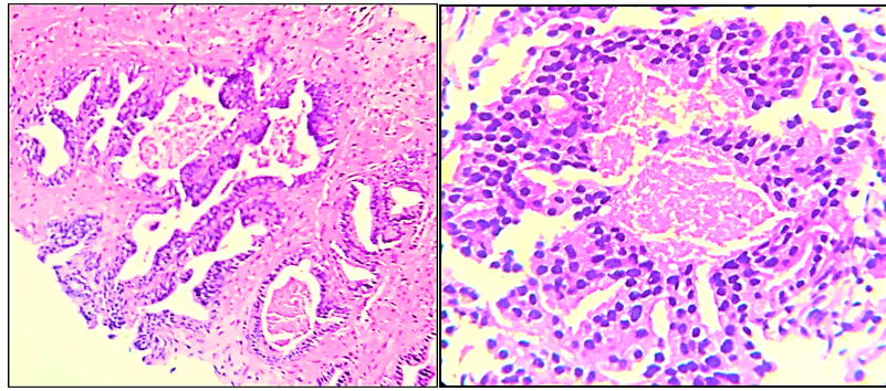 Gleason pattern 5- Central comedonecrosis [H&E@10X &40X]