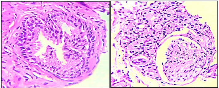 High grade PIN exhibiting tufting and Perineural invasion [H&E@40X]